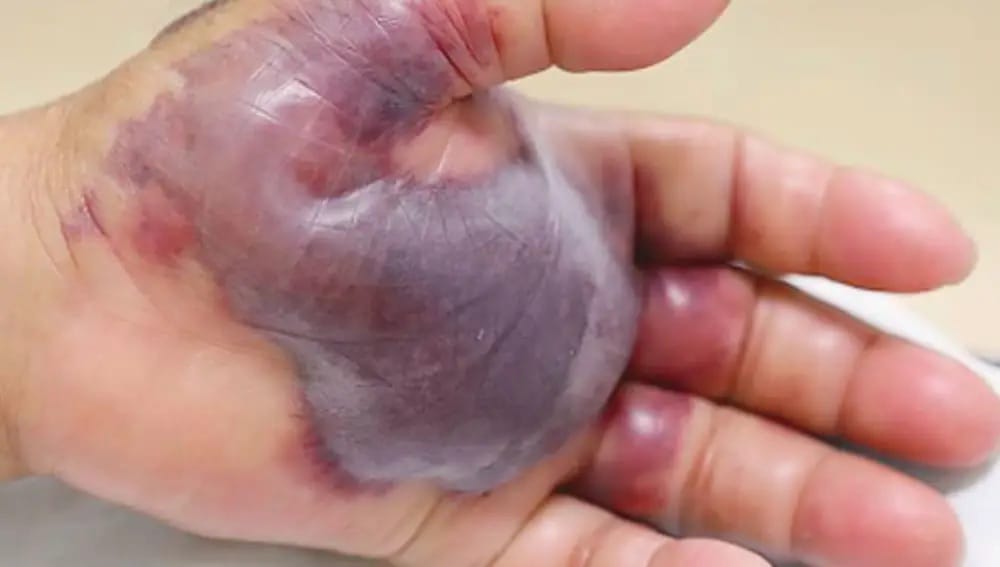 Mão com grande área da palma e dos dedos com pele arroxeada e bolhas, sinal de infecção bacteriana grave em tecido mole (imagem ilustrativa)